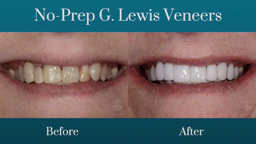 No-prep G. Lewis Veneers
